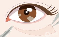 如何消除眼袋呢？有沒有預(yù)防方法?