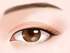 上瞼下垂可以調(diào)節(jié)嗎?有哪些調(diào)節(jié)方法?