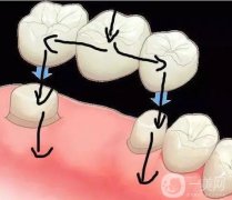 是不是越貴的烤瓷牙越好?