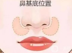 是否需要填充鼻基底如何判斷?