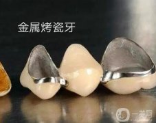 烤瓷牙會發(fā)黑，變色嗎？