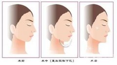 墊下巴能否改良臉型？墊下巴有哪些材料