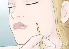 點(diǎn)痣后有哪些注意事項(xiàng)？