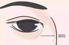 玻尿酸注射填充淚溝可以維持多久？