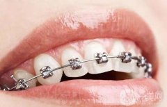 戴牙套的好處和壞處？