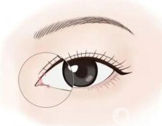 不適合開眼角的人群有哪些？