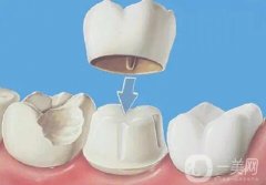 安烤瓷牙需要上麻藥嗎？