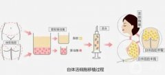 自體脂肪填充面部痛嗎？自體脂肪豐胸滲出怎么辦呢？