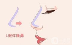 自體軟骨墊鼻尖有什么優(yōu)缺點？