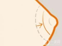 乳暈縮小可能導(dǎo)致哪些副作用？后遺癥？