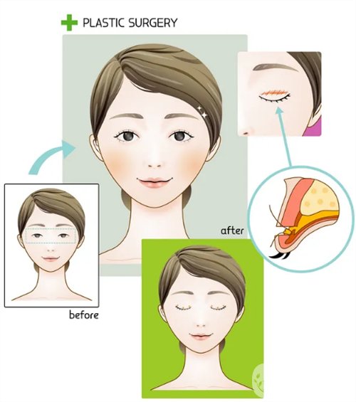 天津璦珊整形醫(yī)院雙眼皮整形日記_價(jià)格表介紹一覽