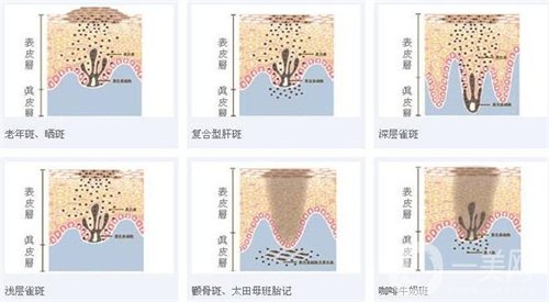 天津醫(yī)科大學(xué)腫瘤醫(yī)院整形科價格表，附激光祛斑恢復(fù)*果圖