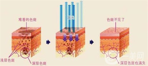 天津醫(yī)科大學(xué)腫瘤醫(yī)院整形科價格表，附激光祛斑恢復(fù)*果圖