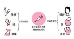 自體脂肪豐胸需要進行多少次手術(shù)？