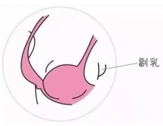 副乳切除后會復(fù)發(fā)嗎？副乳切除術(shù)有什么后遺癥？