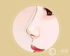 矯正朝天鼻的價(jià)格是多少？