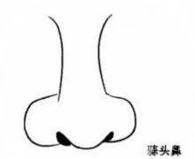如何矯正蒜頭鼻?