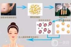 自體脂肪填充一次能填充多少？