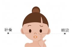 臥蠶手術(shù)需要多少錢呢，臥蠶和眼袋有什么區(qū)別