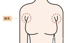 切除副乳后怎么護(hù)理？
