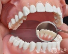 冷光美白牙齒的步驟？哪些人群不適合冷光美白？