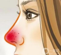 酒渣鼻的病因是什么?有哪些癥狀？