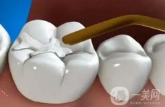 補牙是不是*性的？可以維持多久？