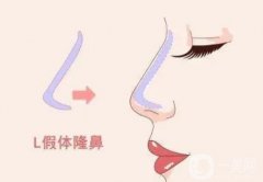 隆鼻后怎么護理能長期保持果?