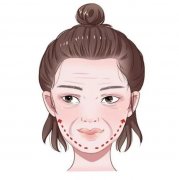 玻尿酸填充法令紋有哪些需要注意?