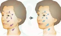 什么人群適合電波拉皮？有什么果？