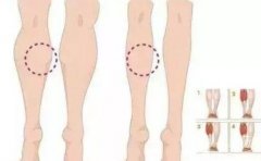 什么年齡適合小腿吸脂?什么人群適合小腿吸脂？