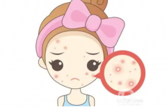 什么因素影響祛痘手術(shù)的價(jià)格？