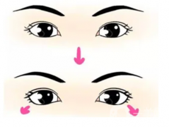 雙眼皮失敗修復(fù)手術(shù)怎么樣？可能的后遺癥有哪些？