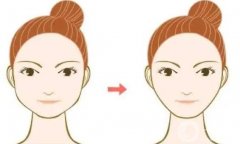 下頜角做截骨術(shù)要戴頭套的原因是什么？