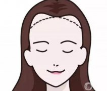 發(fā)際線太高怎么辦
