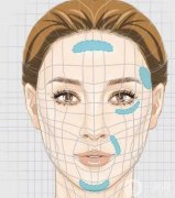 豐面頰手術需要多少錢，哪些人群適合注射豐頰？