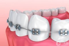 矯正牙齒有哪幾種類型？