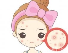 紅藍光祛痘會很疼嗎