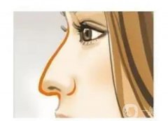 可以矯正鷹鉤鼻嗎?