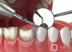 洗牙會(huì)不會(huì)傷牙，洗牙后牙齒出現(xiàn)松動(dòng)怎么辦？