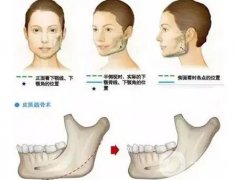 下頜角整形手術(shù)后有多長(zhǎng)的恢復(fù)期？