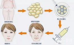 臥蠶可以填充自體脂肪嗎？