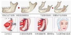 下頜角截骨術(shù)存在風(fēng)險和后遺癥嗎？