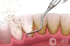 洗牙后牙齦出血怎么辦？洗完牙應(yīng)該怎么護(hù)理？