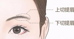 提眉手術(shù)后多久可以恢復(fù)自然？