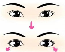 下眼瞼手術(shù)有哪些風(fēng)險(xiǎn)？