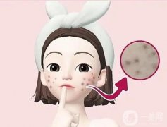 激光去痘印可能存在什么風(fēng)險(xiǎn)?