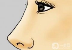 取出鼻假體后有哪些護(hù)理方法?