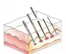 微針是什么？有什么作用？