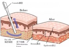 水動(dòng)力吸脂會(huì)留下疤痕嗎？水動(dòng)力吸脂術(shù)的優(yōu)點(diǎn)有哪些？
